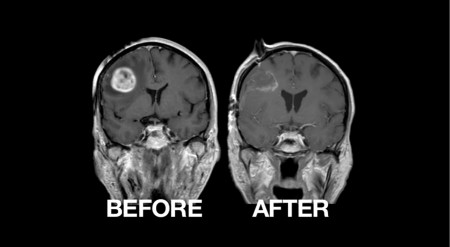 Tomada de: https://fmv-lm01.ehost.aol.com/ultrasonic-brain-tumor-removal-517791335