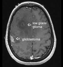Tomada de: https://www.aboutcancer.com/brain_anatomy_abnormal.htm